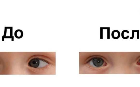 В детском клиническом центре имени Л. М. Рошаля успешно прооперировали ребенка с косоглазием