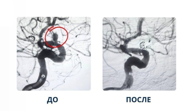 В Красногорской больнице успешно применили новую методику лечения аневризмы сосудов головного мозга