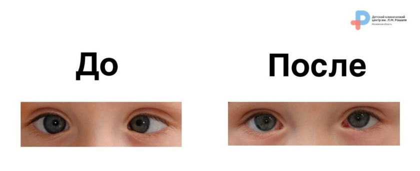 В детском клиническом центре имени Л. М. Рошаля успешно прооперировали ребенка с косоглазием