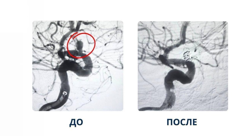 В Красногорской больнице успешно применили новую методику лечения аневризмы сосудов головного мозга