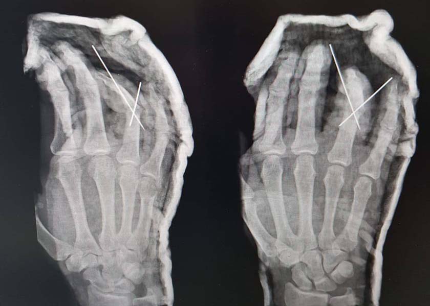 Красногорские врачи реплантировали пациенту оторванный кольцом палец